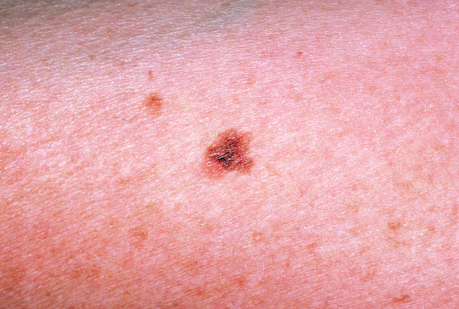 Malignant Melanoma Skin Cancer Cell