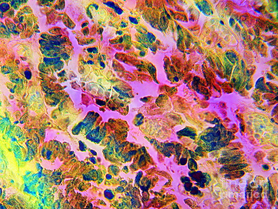 Malignant Melanoma Photograph by Dr Cecil H Fox