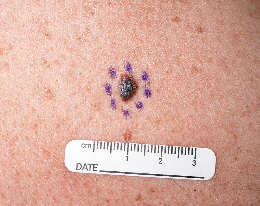 Malignant Melanoma Photograph by National Cancer Institute/science Photo Library