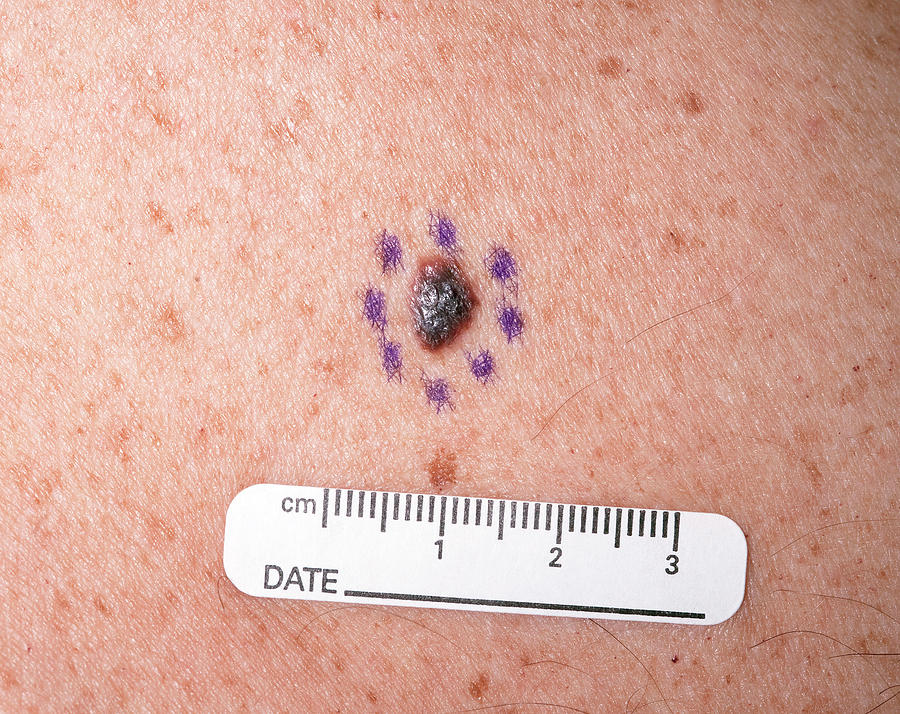 Stage Melanoma | lupon.gov.ph