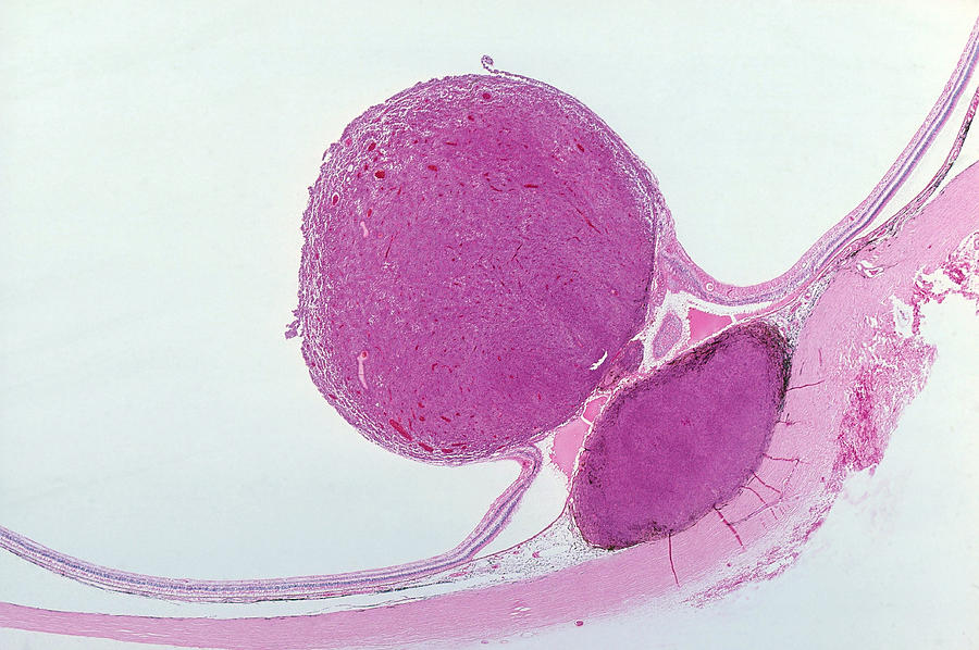 Malignant Melanoma Of Retina, Lm Photograph by Michael Abbey
