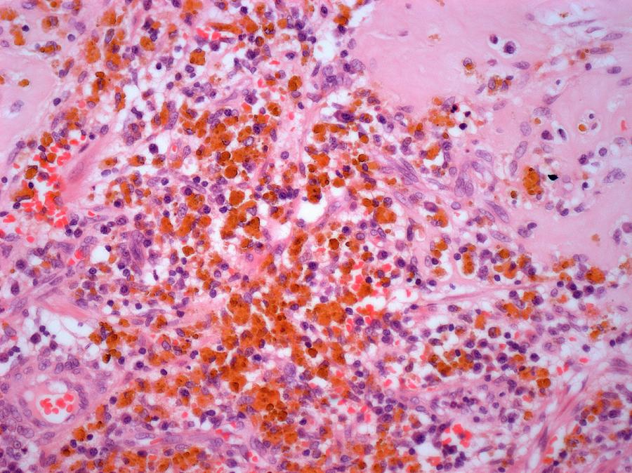 Malignant Melanoma Photograph by Steve Gschmeissner
