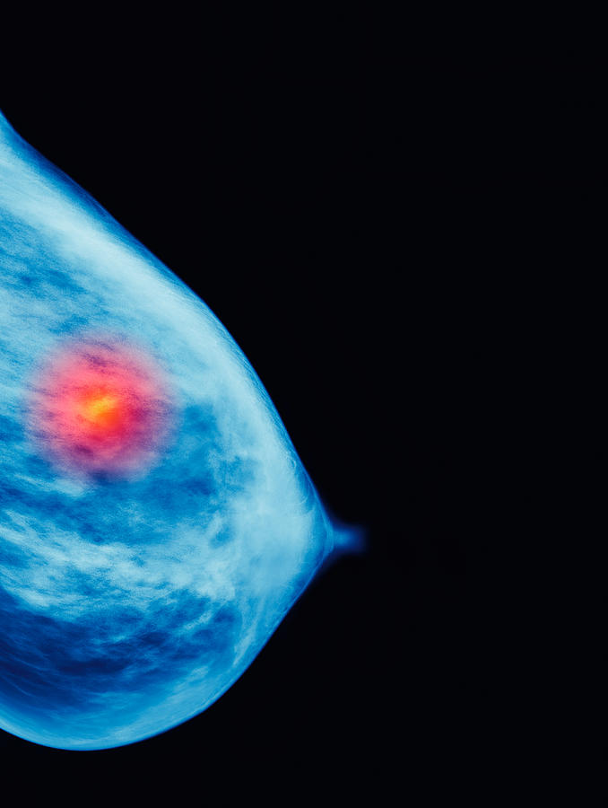 Mammogram showing cancer growth Photograph by Peter Dazeley