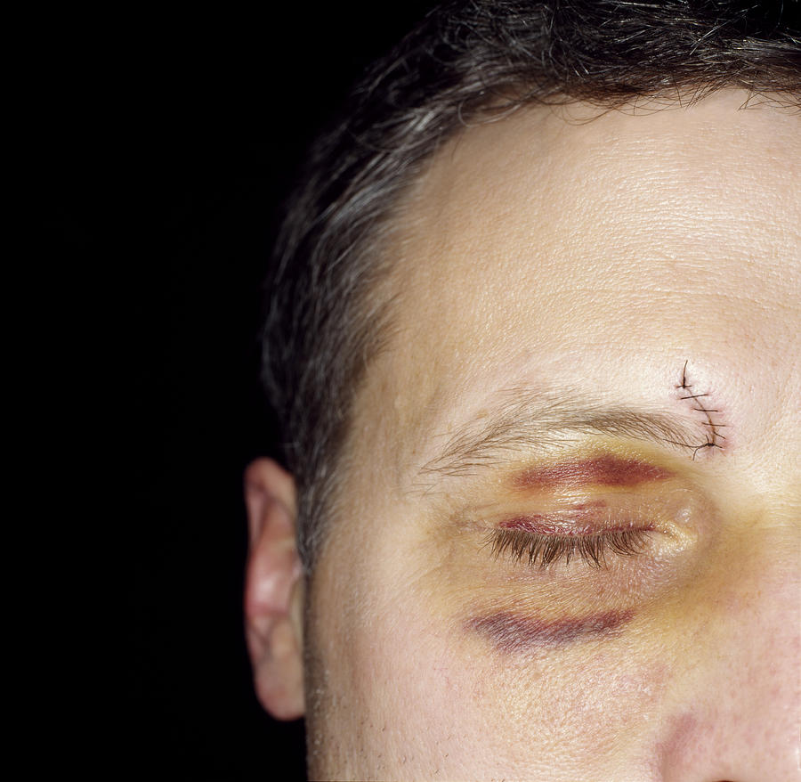 Man with black eye and stiches, close-up Photograph by Dana Neely