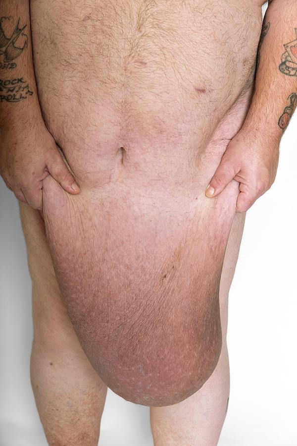 Man With Excess Skin After Weight Loss