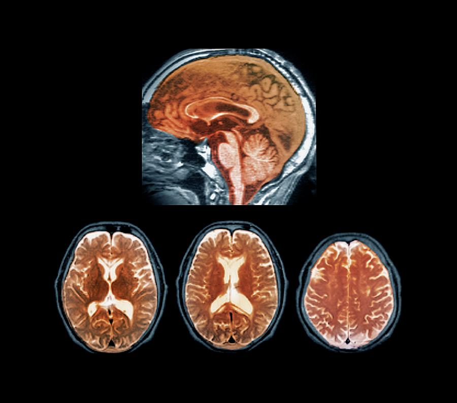 Marchiafava-bignami Disease Photograph by Zephyr/science Photo Library