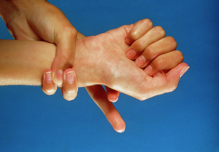 marfan-s-syndrome-joint-laxity-and-long-fingers-photograph-by-medical