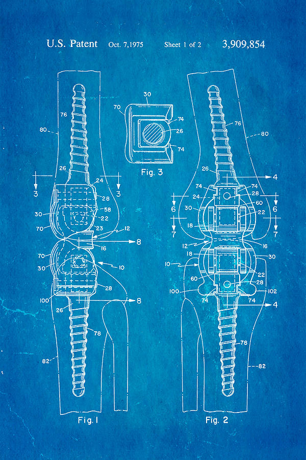 Appliance Photograph - Martinez Knee Implant Prosthesis Patent Art 1974 Blueprint by Ian Monk