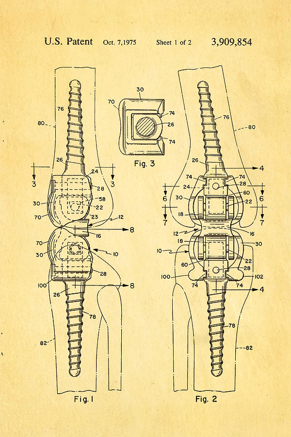 Appliance Photograph - Martinez Knee Implant Prosthesis Patent Art 1974 by Ian Monk