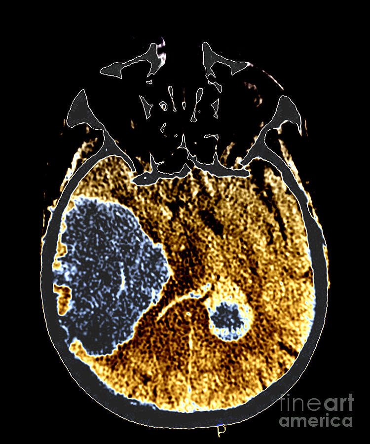 Massive Intracranial Hemorrhage, Ct Scan Photograph by Living Art Enterprises
