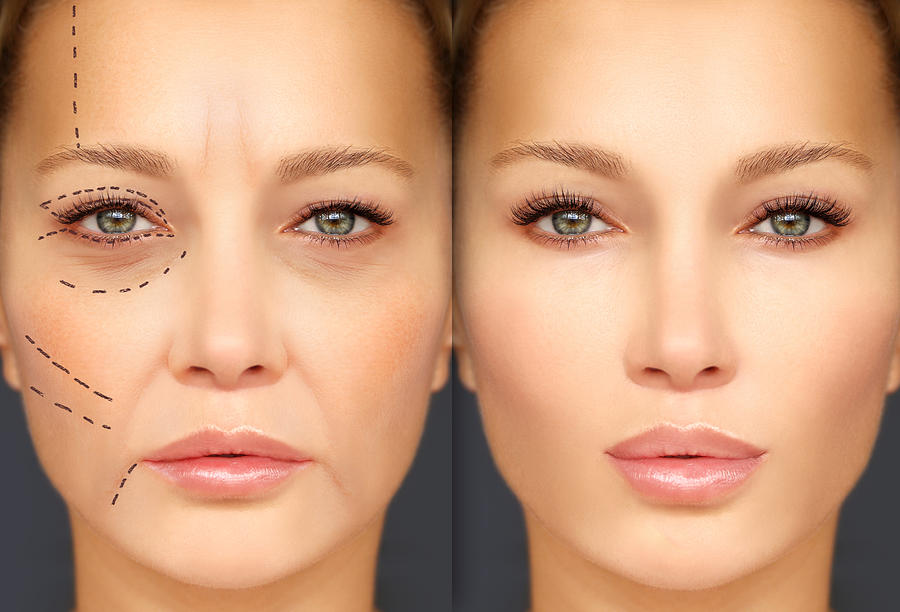 Mature woman-young woman.Endoscopic forehead and brow lift.Marking the face.Perforation lines on females face, plastic surgery concept. Photograph by GMint