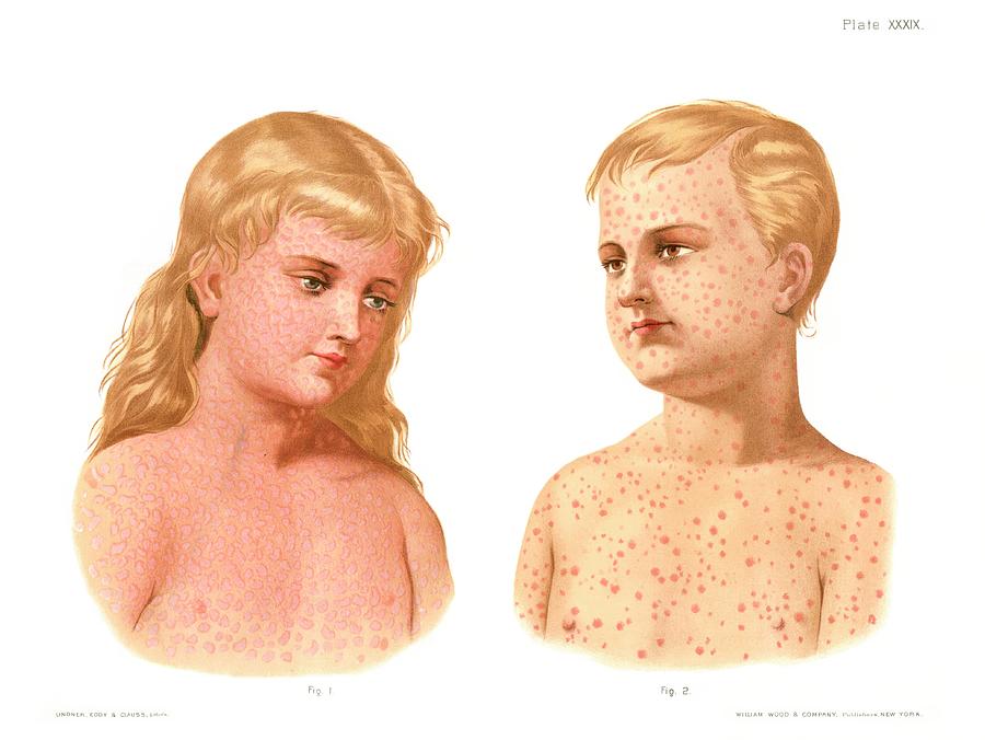 Measles And German Measles Photograph by Us National Library Of Medicine/science Photo Library