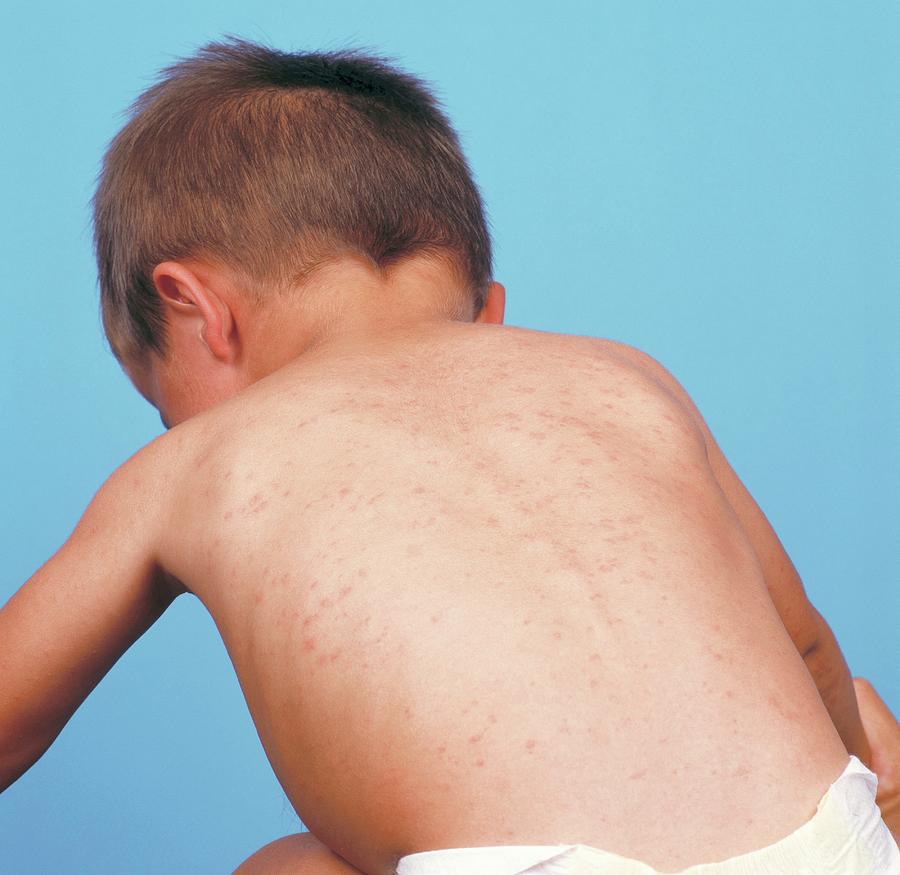 Measles Rash Photograph By Alex Bartelscience Photo Library Pixels