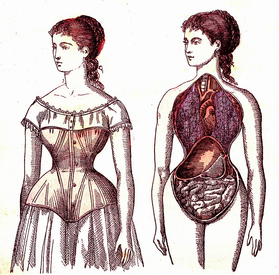 Medical Effects Of Corset Wearing by Collection Abecasis/science Photo  Library