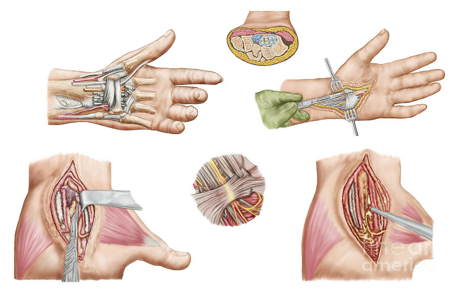 Human Hands Digital Art - Medical Illustration Showing Carpal by Stocktrek Images