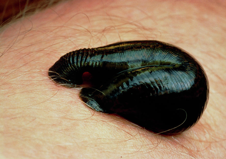 Medicinal Leech Sucking Blood From Human Photograph by Martin Dohrn/science Photo Library