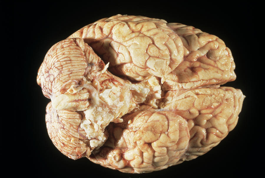 Meningioma Brain Tumour Photograph by Cnri/science Photo Library