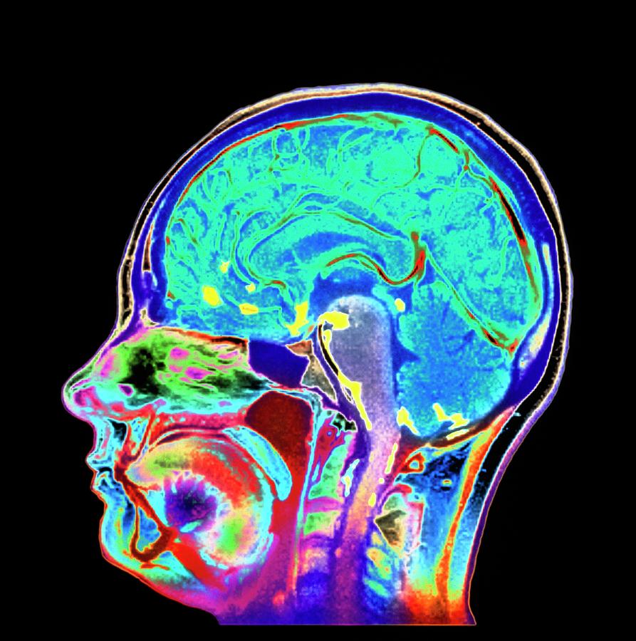 Meningitis Brain Scan Photograph by Simon Fraser/newcastle Hospitals ...