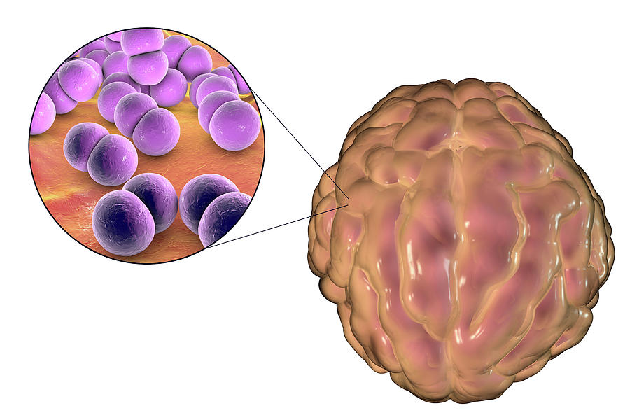 bacterial-meningitis-ct-scan