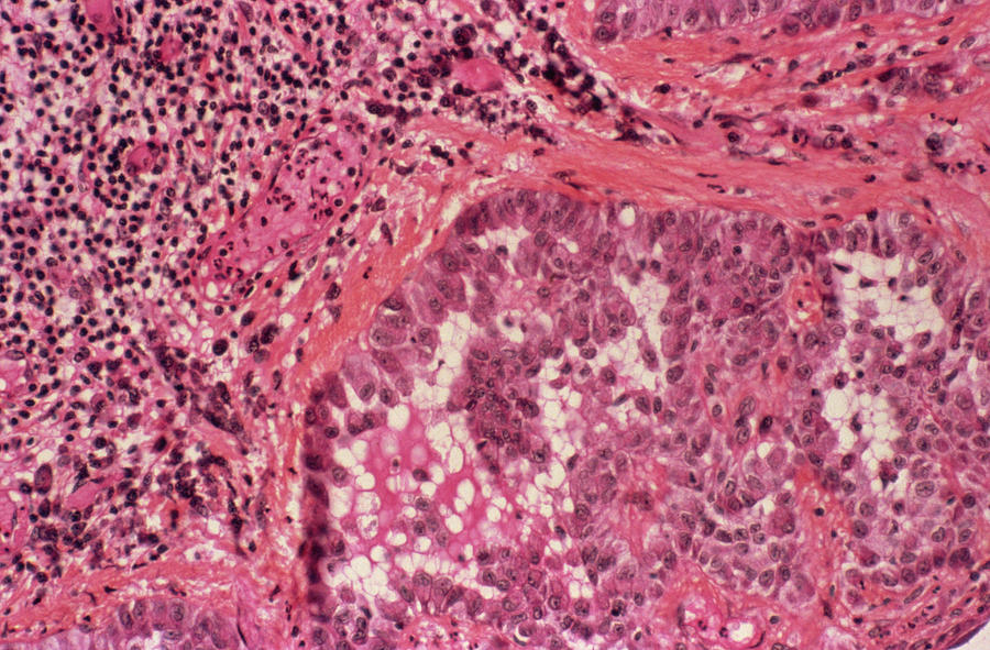 Mesothelioma Cancer Photograph by Cnri/science Photo Library