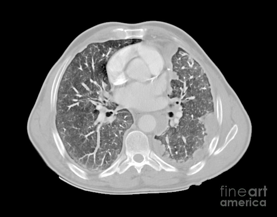Mesothelioma Lung Cancer, Ct Scan Photograph by Du Cane Medical Imaging Ltd