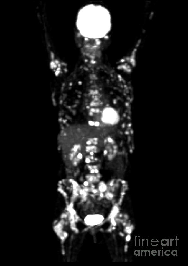 Metastatic Disease Pet Scan Photograph by Living Art Enterprises