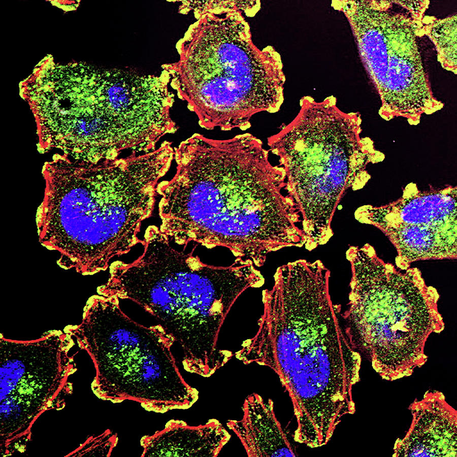 Metastatic Melanoma Cells Photograph by Nci Center For Cancer Research/national Cancer Institute/science Photo Library