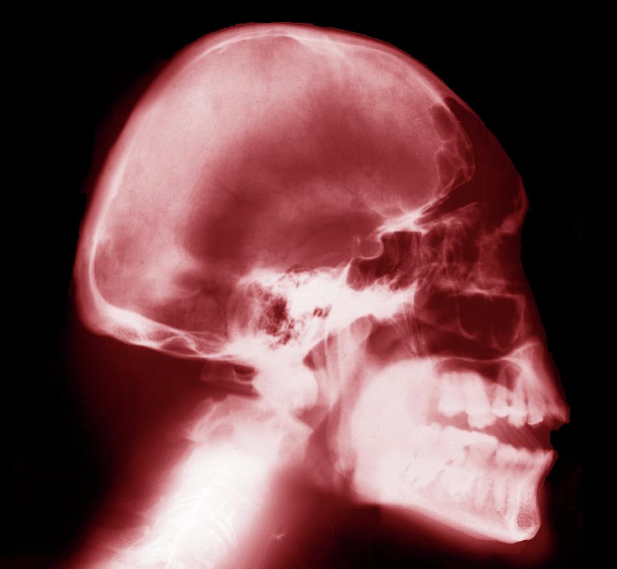 Skull Photograph - Microcephaly by Zephyr