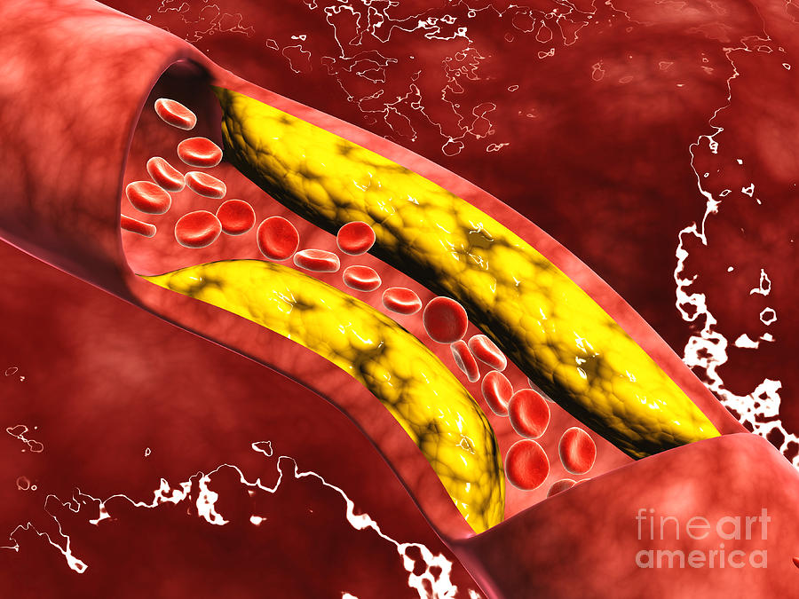 Bloodstream Digital Art - Microscopic View Of Fat Plaque by Stocktrek Images
