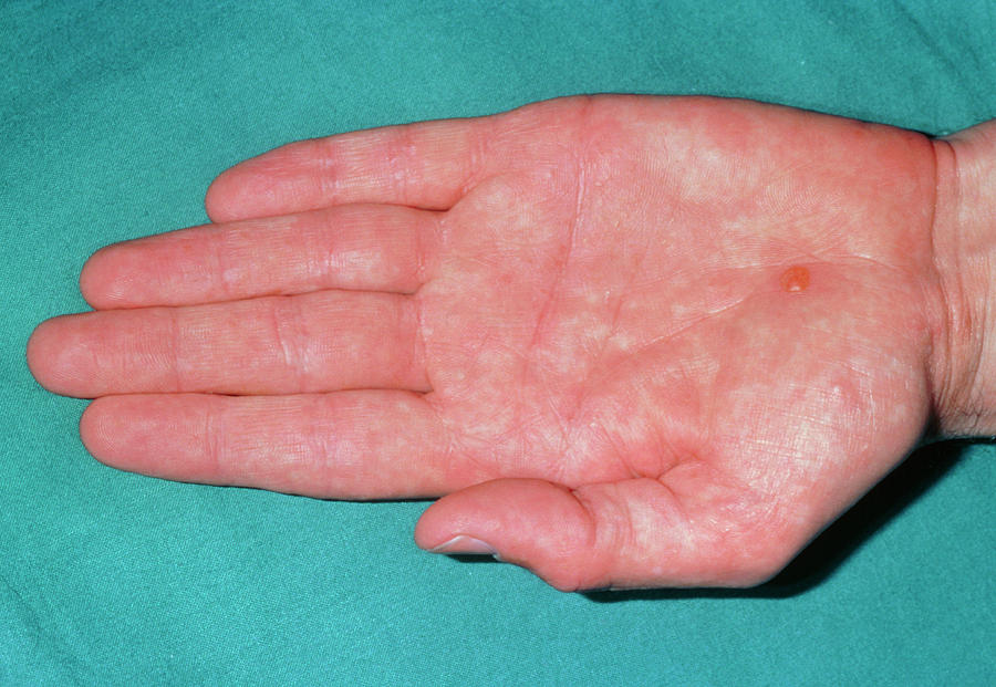 Mild Form Of Pompholyx Eczema Over The Palm Photograph By Dr P Marazzi Science Photo Library