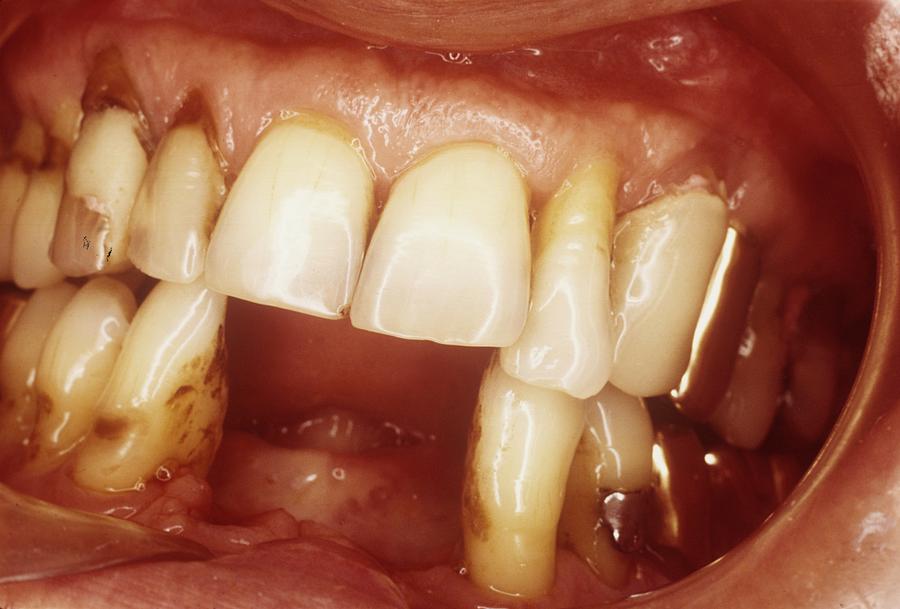 Missing Teeth Photograph by Dr. M. Gaillard/cnri/science Photo Library