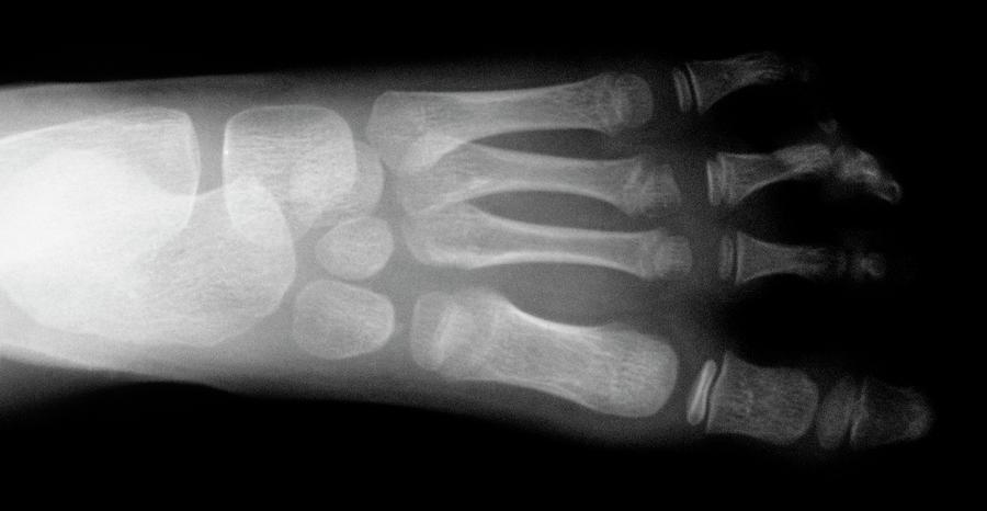 Missing Toe Birth Malformation  Photograph by Mike Devlin/science Photo Library