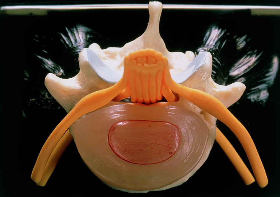 Model Of An Intervertebral Disc From A Human Spine Photograph by Mike ...