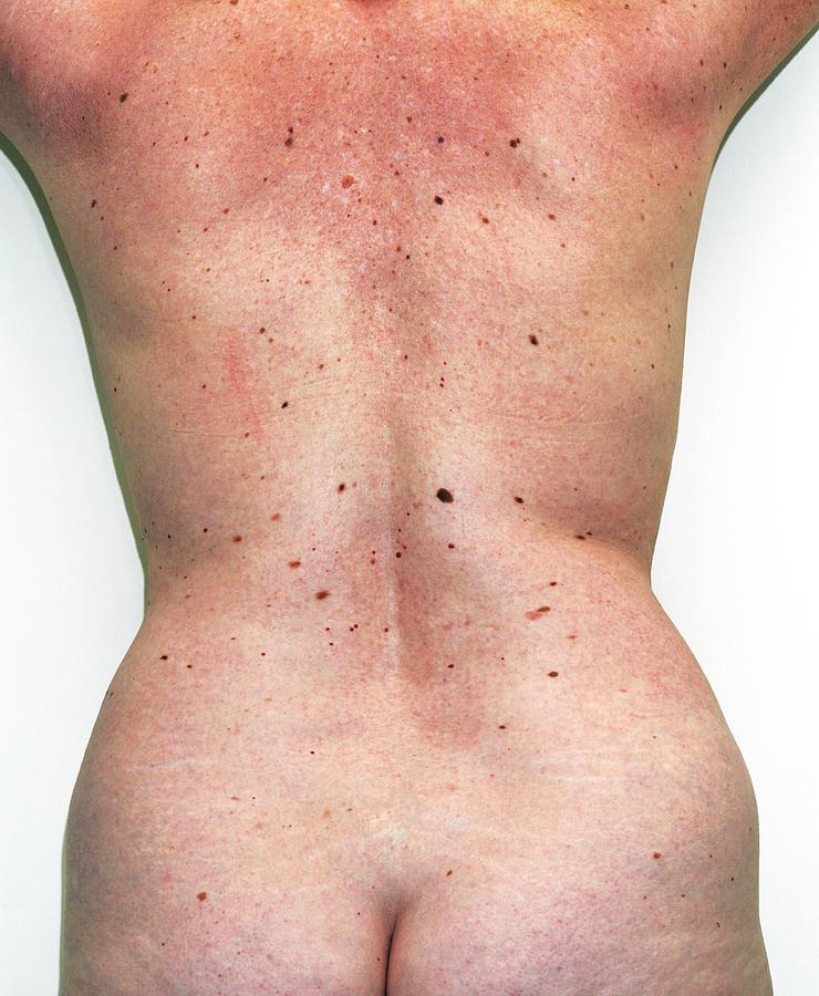 Moles On A Womans Back Photograph by Dr M.a. Ansary/science Photo Library