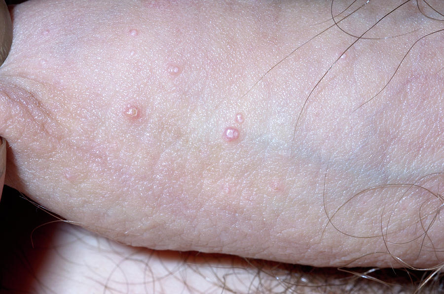 molluscum contagiosum on the penis Xxx blue-ray movies