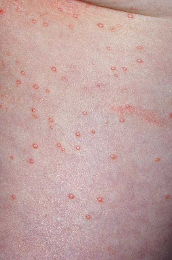 Molluscum Contagiosum On The Thigh Photograph by Dr P. Marazzi/science ...