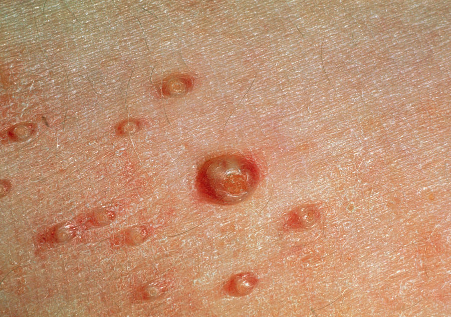 Molluscum Contagiosum Skin Infection Photograph By Dr P Marazzi My Xxx Hot Girl