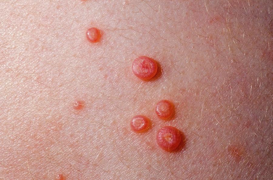 Molluscum Contagiosum Skin Nodules Photograph by Dr P. Marazzi/science ...