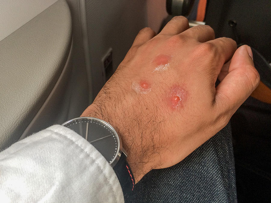 Mosquito bites on male hand Photograph by Photo by Stuart Gleave