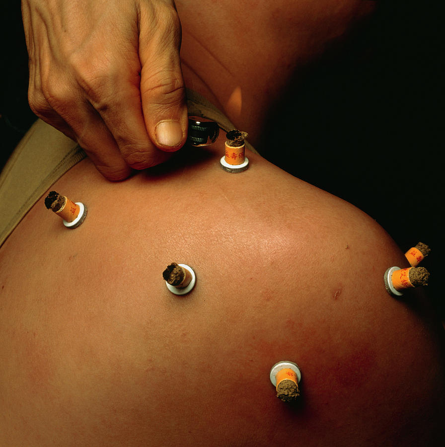 Lighter Photograph - Moxibustion by Mark De Fraeye/science Photo Library