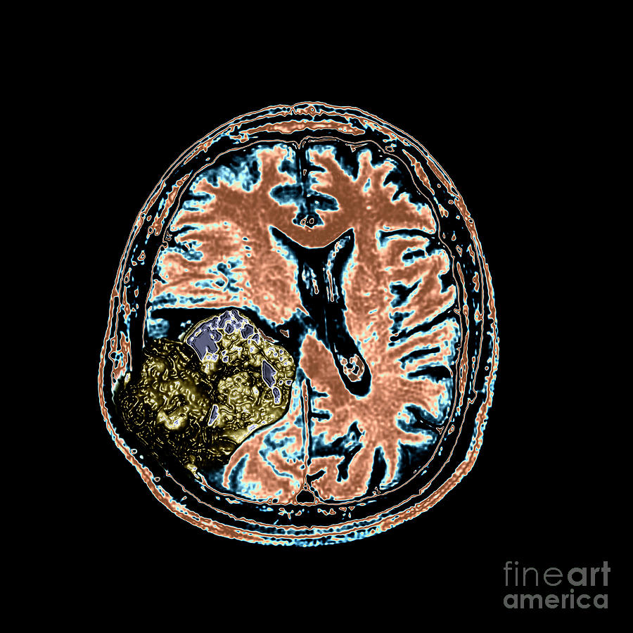 Mr Of Malignant Brain Tumor 2 Of 3 Photograph by Living Art Enterprises