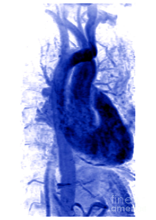 Magnetic Resonance Angiography Photograph - Mra, Normal Heart by Living Art Enterprises