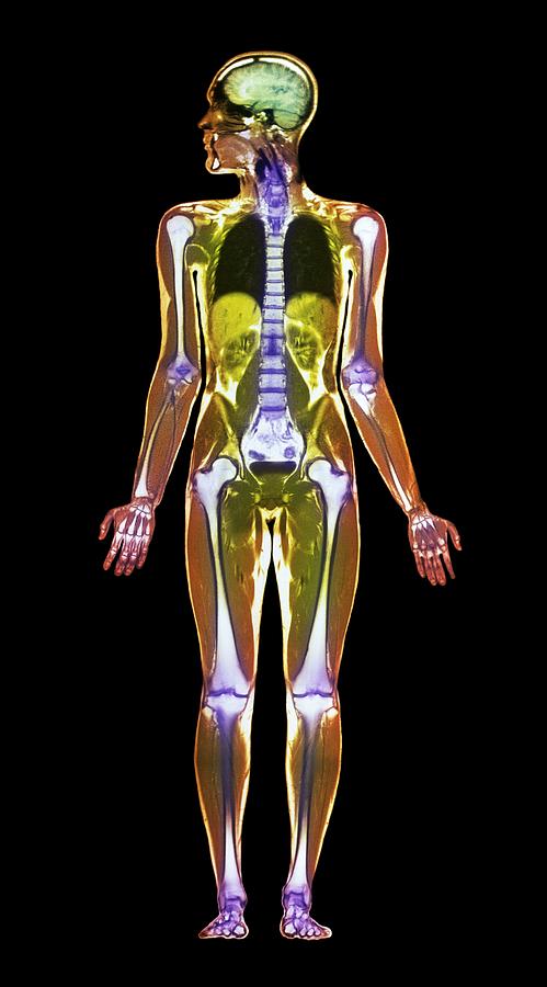 Skeleton Photograph - Mri Body Scan by Simon Fraser/science Photo Library