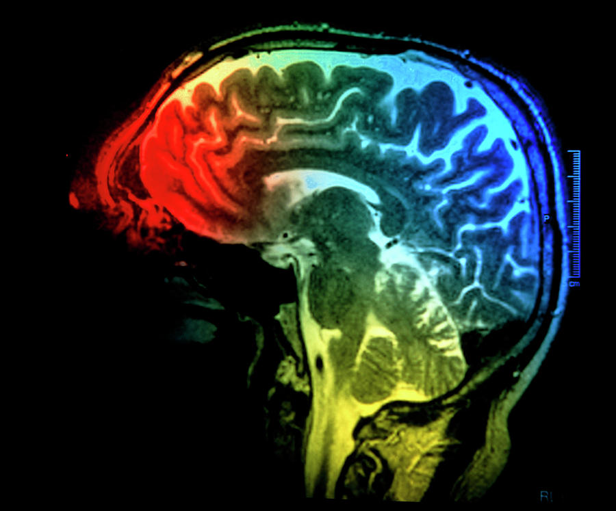 Mri Brain Scan Photograph by Mark Thomas/science Photo Library