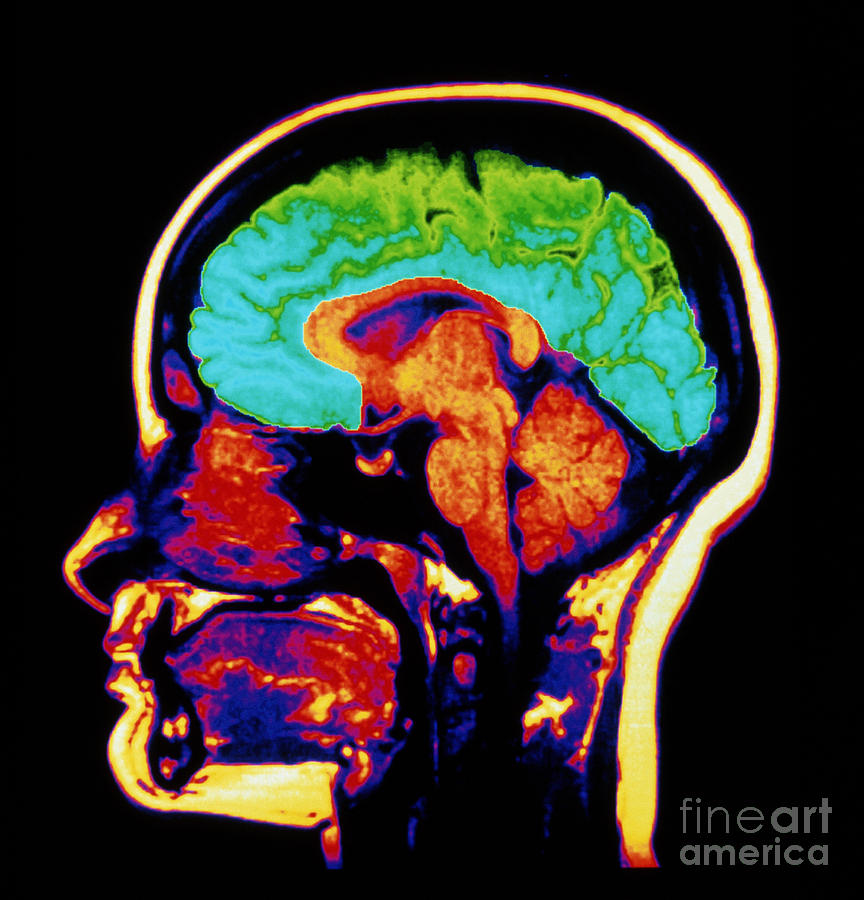 Mri Brain Scan Photograph by Scott Camazine