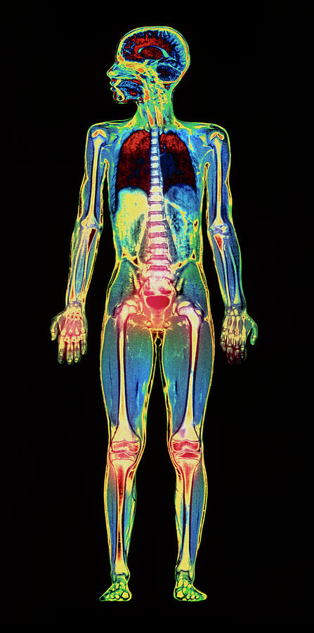 Skeleton Photograph - Mri Child Body Scan by Simon Fraser/science Photo Library