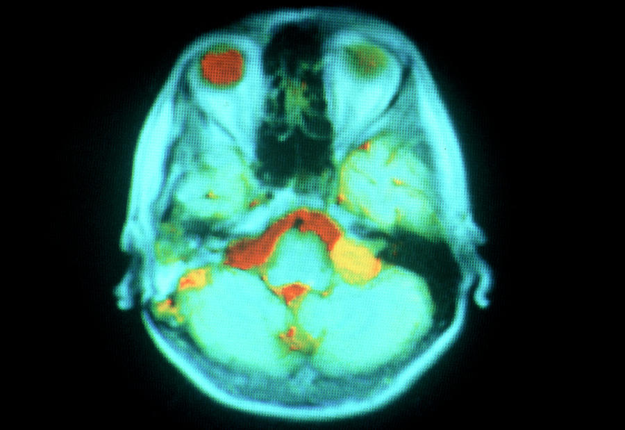 Mri Image Of An Acoustic Neuroma Tumour Photograph by Gec Research/hammersmith Hospital Medical School/science Photo Library.
