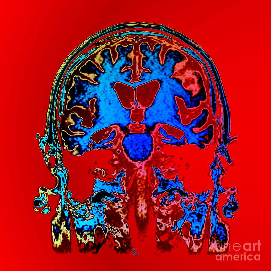 Mri Of Alzheimers Disease Photograph by Living Art Enterprises