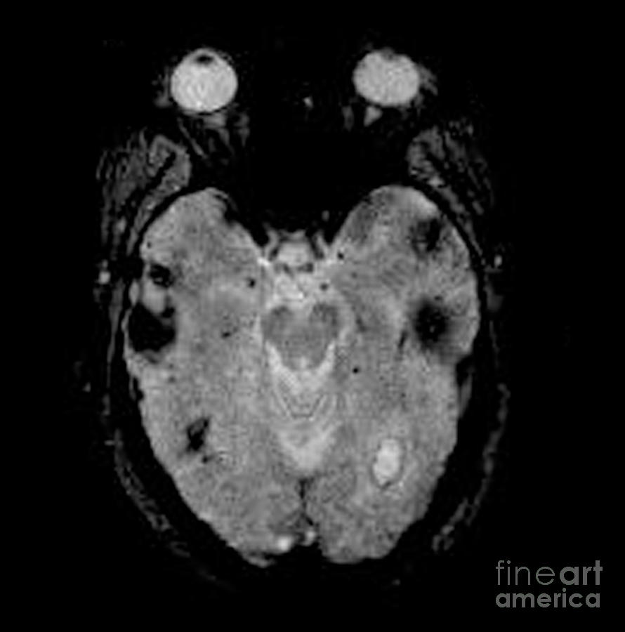 MRI of Amyloid Angiopathy Photograph by Living Art Enterprises