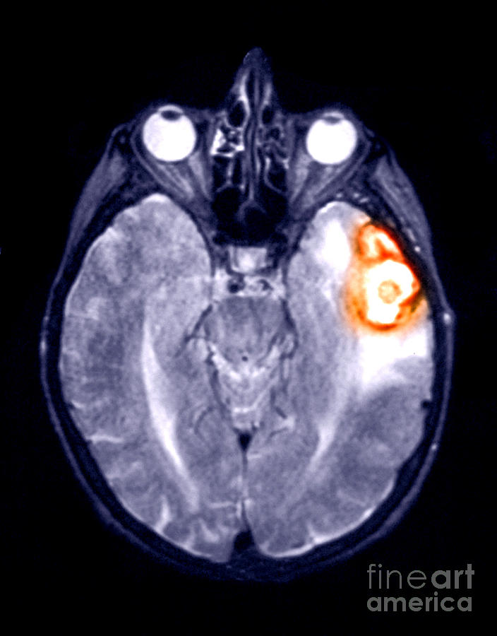 Mri Scan Of A Brain Hemorrhage Photograph by Scott Camazine